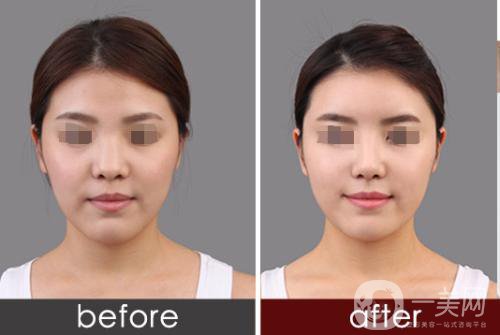 專業(yè)隆鼻修復(fù)手術(shù)的價(jià)格一般是多少？