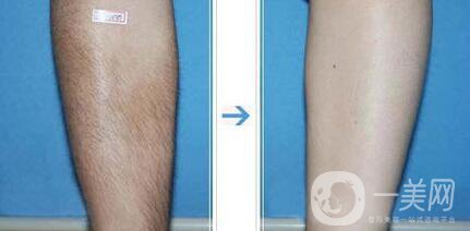 激光脫毛有哪幾種 激光脫毛是*的嗎