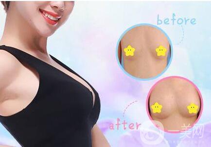 雙平面假體豐胸,怎么樣