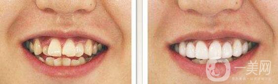 t4a牙齒矯正器佩戴方法