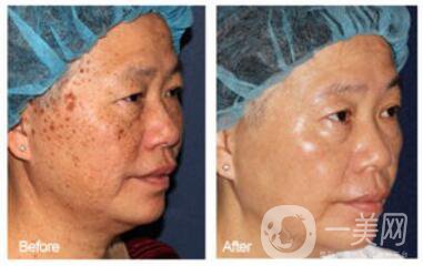 老年斑的形成 身上長老年斑是什么原因