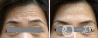 長抬頭紋怎么辦 去抬頭紋*方法介紹