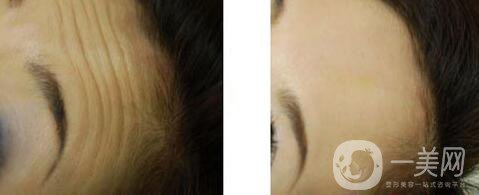 長抬頭紋怎么辦 去抬頭紋*方法介紹