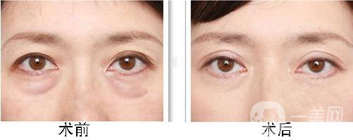 超聲波去眼袋多少錢 超聲波去眼袋價(jià)格詳情