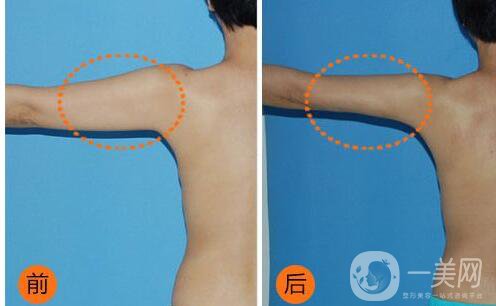 水動力溶脂,減肥,價格