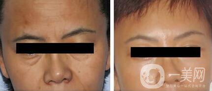 怎樣去抬頭紋 如何消除抬頭紋