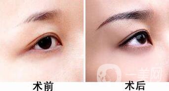 種植眉毛一般要多少錢 植眉價(jià)格詳解