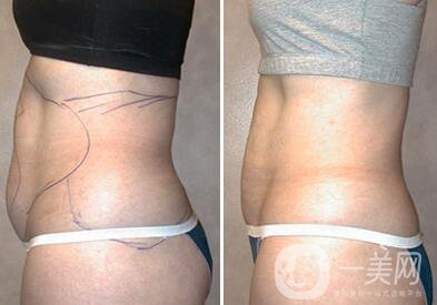 鐳射溶脂副作用？鐳射溶脂*果怎么樣