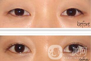 手術(shù)開眼角要多少錢 開眼角的費用