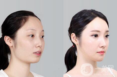 磨腮削骨多少錢？腮幫子磨骨多少錢？