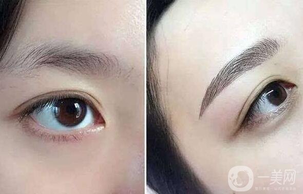 北京眉整形多少錢？?jī)r(jià)格是多少？