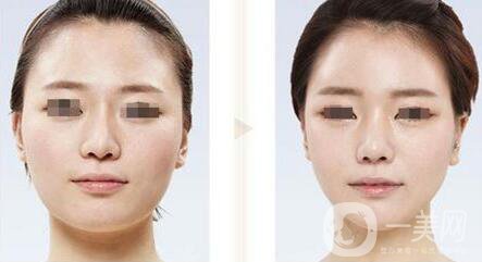 臉部削骨手術(shù)多少錢 削骨瘦臉手術(shù)價格詳情