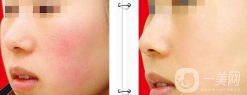 彩光祛紅血絲多少錢 彩光祛紅血絲價(jià)格介紹