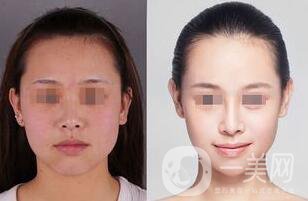 像素激光美容多少錢 像素激光美容價(jià)格詳解