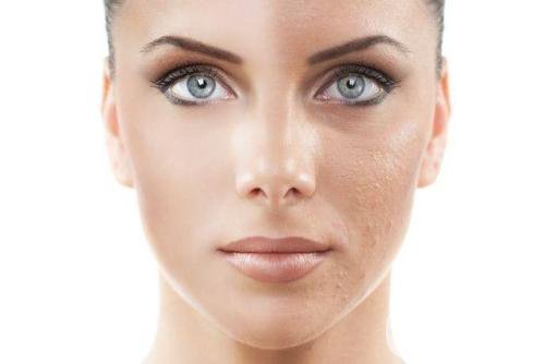 果酸換膚的危害 后遺癥主要有哪些？