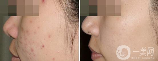 果酸換膚的危害 后遺癥主要有哪些？