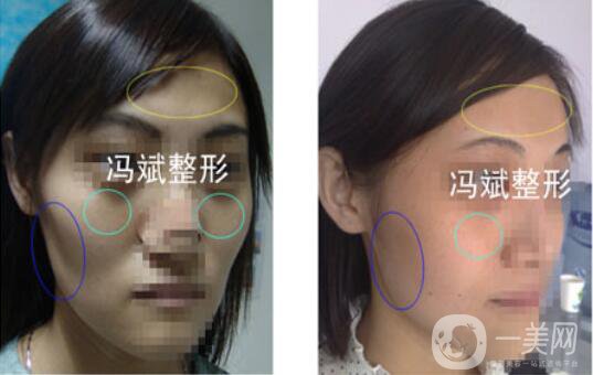 北京東方和諧馮斌整形價(jià)格表2018國(guó)慶特惠出爐