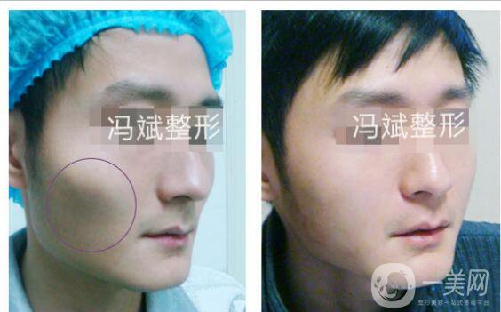 北京東方和諧馮斌整形價(jià)格表2018國(guó)慶特惠出爐