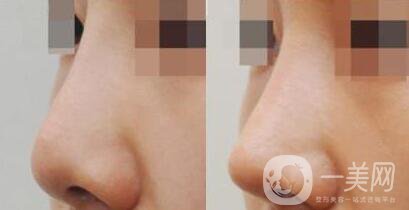 耳軟骨墊鼻梁的壞處 耳軟骨墊鼻梁會被吸收嗎