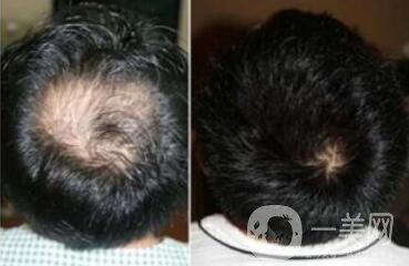 蛋白纖維植發(fā)多少錢 北京蛋白纖維植發(fā)價格