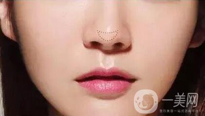 歪鼻矯正注意事項(xiàng)有哪些？