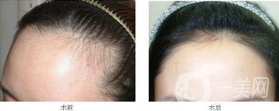 北京植發(fā)醫(yī)院信息介紹？哪里植發(fā)好？