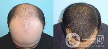 北京植發(fā)醫(yī)院信息介紹？哪里植發(fā)好？