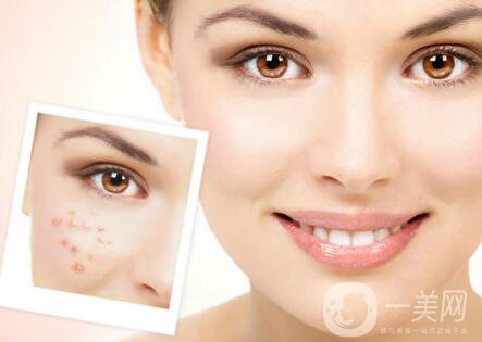 像素激光調(diào)節(jié)痘坑*果怎么樣？