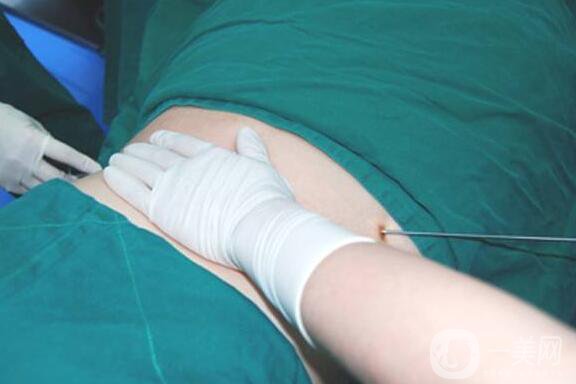 超聲波抽脂,風(fēng)險