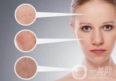 像素激光祛斑,價格