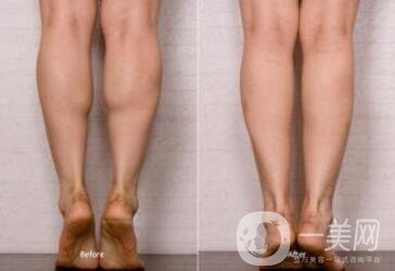 在上海*瘦小腿需要多少錢