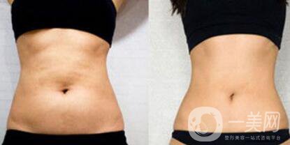 超聲波抽脂價格多少？超聲波抽脂有什么優(yōu)點？