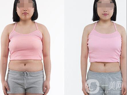 超聲波抽脂價格多少？超聲波抽脂有什么優(yōu)點？