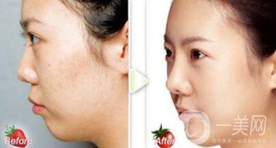 正規(guī)醫(yī)院做果酸換膚要多少錢？