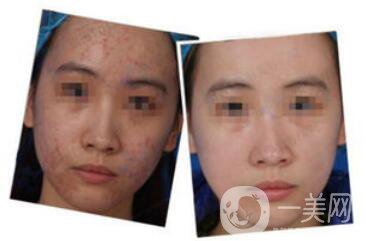 正規(guī)醫(yī)院做果酸換膚要多少錢？