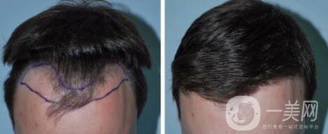 fue植發(fā)缺點(diǎn)和優(yōu)點(diǎn)分別是什么