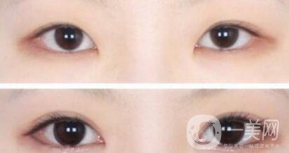 開眼角手術(shù)醫(yī)院介紹？開眼角哪好？