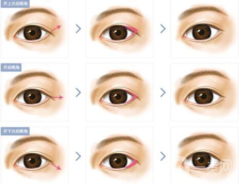 開眼角手術(shù)醫(yī)院介紹？開眼角哪好？