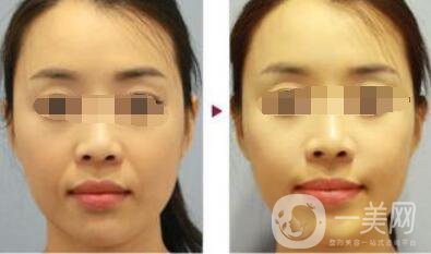 上海正規(guī)醫(yī)院去法令紋少錢