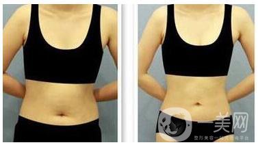 深圳腰腹部溶脂價(jià)格需要多少錢