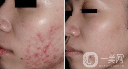 杭州做個果酸換膚大概多少錢