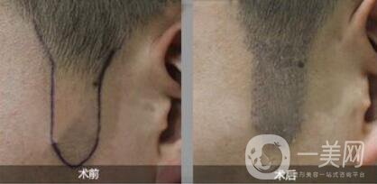 正規(guī)的醫(yī)院做植鬢角手術(shù)多少錢