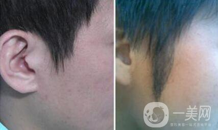 正規(guī)的醫(yī)院做植鬢角手術(shù)多少錢