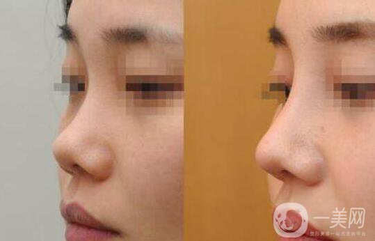 成都朝天鼻整容大概要多少錢