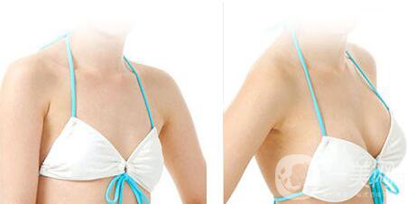 妙桃假體豐胸大概多少錢(qián)一次