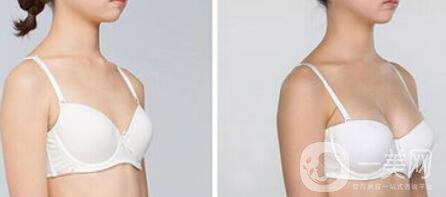 妙桃假體豐胸大概多少錢(qián)一次