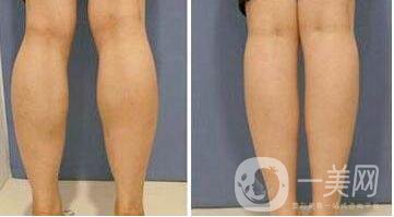 *,瘦小腿,多少錢