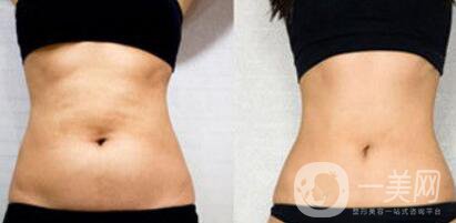 上海腰腹部抽脂具體多少錢