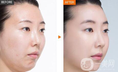 北京正規(guī)醫(yī)院嫩膚具體多少錢