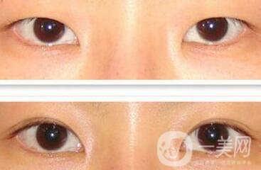 在濟南割雙眼皮費用是多少